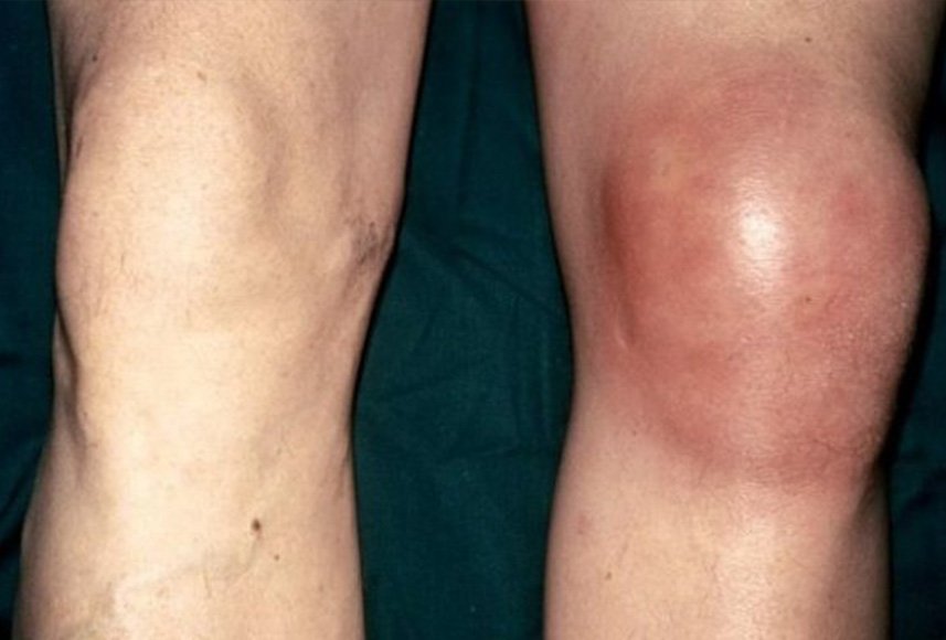 Alimentatie Inflamatorie